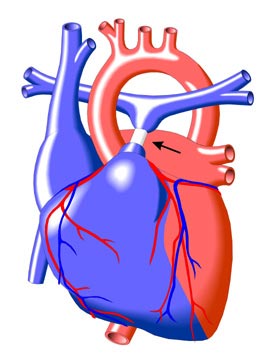 Pulmonary Band